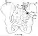 Fig. 89 - Spinopelvic fixation technology