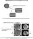 Fig. 08 - Vision correction with laser refractive index changes