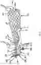 Fig. 06 - Anterior boot for hip distraction