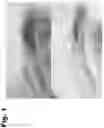 Fig. 02 - Tattoo removal