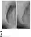 Fig. 03 - Tattoo removal