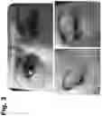 Fig. 04 - Tattoo removal