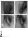 Fig. 05 - Tattoo removal