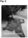 Fig. 07 - Tattoo removal