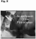 Fig. 09 - Tattoo removal