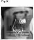 Fig. 10 - Tattoo removal