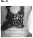 Fig. 12 - Tattoo removal