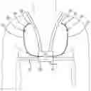Fig. 01 - Cannula assembly for fitting a flow cannula for introducing, circulating or diverting flow media, and method for extracorporeal support of a patient with pulmonary hypertension or pulmonary insufficiency