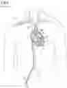 Fig. 02 - Cannula assembly for fitting a flow cannula for introducing, circulating or diverting flow media, and method for extracorporeal support of a patient with pulmonary hypertension or pulmonary insufficiency