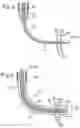 Fig. 04 - Cannula assembly for fitting a flow cannula for introducing, circulating or diverting flow media, and method for extracorporeal support of a patient with pulmonary hypertension or pulmonary insufficiency