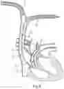 Fig. 06 - Cannula assembly for fitting a flow cannula for introducing, circulating or diverting flow media, and method for extracorporeal support of a patient with pulmonary hypertension or pulmonary insufficiency