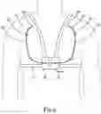 Fig. 07 - Cannula assembly for fitting a flow cannula for introducing, circulating or diverting flow media, and method for extracorporeal support of a patient with pulmonary hypertension or pulmonary insufficiency