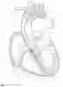 Fig. 02 - Balloon dilation assembly with AV node/HIS bundle sensing-stimulation system