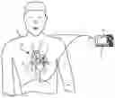 Fig. 01 - Dual sensor electrodes for providing enhanced resuscitation feedback
