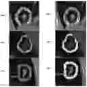 Fig. 01 - Distinguishing hyperprogression from other response patterns to PD1/PD-L1 inhibitors in non-small cell lung cancer with pre-therapy radiomic features