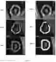 Fig. 09 - Distinguishing hyperprogression from other response patterns to PD1/PD-L1 inhibitors in non-small cell lung cancer with pre-therapy radiomic features