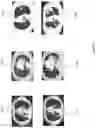 Fig. 14 - Distinguishing hyperprogression from other response patterns to PD1/PD-L1 inhibitors in non-small cell lung cancer with pre-therapy radiomic features