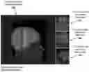 Fig. 01 - Cortical malformation identification