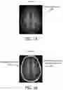 Fig. 02 - Cortical malformation identification