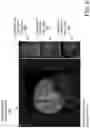 Fig. 06 - Cortical malformation identification