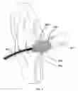 Fig. 05 - EAR PHONE SYSTEM