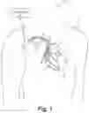 Fig. 02 - Absolute intrathoracic impedance based scheme to stratify patients for risk of a heart failure event