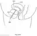 Fig. 320 - Robotic catheter system and methods