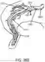 Fig. 20 - UNITARY BODY SYSTEMS AND DEVICES AND METHODS TO USE THE SAME FOR RETROPERFUSION