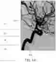 Fig. 02 - Aspiration catheter systems and methods of use
