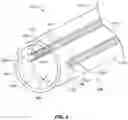 Fig. 03 - Deflectable catheter shaft with pullwire anchor feature