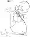 Fig. 02 - Transvenous Phrenic Nerve Stimulation System