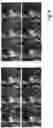 Fig. 08 - Deep learning reconstruction of free breathing perfusion