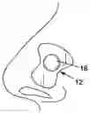 Fig. 01 - STEMLESS MOUNTING SYSTEM FOR AN EYEWEAR LENS