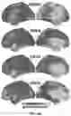 Fig. 10 - Methods and systems for computer-generated predictive application of neuroimaging and gene expression mapping data