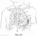 Fig. 03 - Automatic thresholds for atrial tachyarrhythmia detection in an implantable medical device