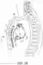 Fig. 04 - Automatic thresholds for atrial tachyarrhythmia detection in an implantable medical device