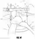 Fig. 22 - Hip surgery systems and methods