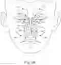 Fig. 04 - Method of treating deviated nasal septum, enlarged nasal turbinate, or mucosal hypertrophy