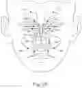 Fig. 06 - Method of treating deviated nasal septum, enlarged nasal turbinate, or mucosal hypertrophy