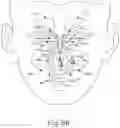 Fig. 22 - Method of treating deviated nasal septum, enlarged nasal turbinate, or mucosal hypertrophy