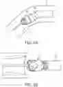 Fig. 06 - Devices systems and methods for cutting and removing occlusive material from a body lumen