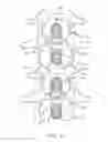 Fig. 07 - METHODS AND SYSTEMS FOR LATERALLY STABILIZED CONSTRAINT OF SPINOUS PROCESSES