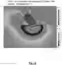 Fig. 13 - Heat transfer through a catheter tip