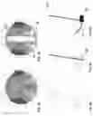 Fig. 04 - Astigmatism correction