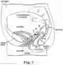 Fig. 06 - Method of treating prolapse of a vagina
