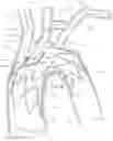 Fig. 01 - Thoracic aorta stent graft