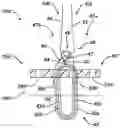 Fig. 01 - Implant having filament limbs of an adjustable loop disposed in a shuttle suture