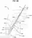 Fig. 08 - Implant having filament limbs of an adjustable loop disposed in a shuttle suture