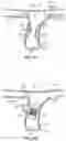 Fig. 35 - DEVICES AND SYSTEMS FOR DOCKING A HEART VALVE