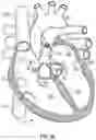 Fig. 44 - DEVICES AND SYSTEMS FOR DOCKING A HEART VALVE